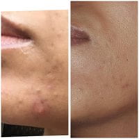 IPL Laser Skin Rejuvenation/ Acne Orpington,Bromley, Beauty Salon in Orpington, Bromley